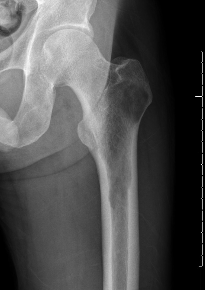 x-ray of lytic metastatic lesion in the femur