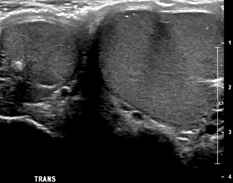 Compensatory testicular hypertrophy Radiology Case