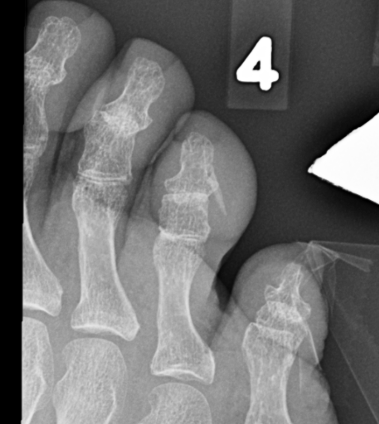 Foreign Body in the Toe | Radiology Case | Radshare.net